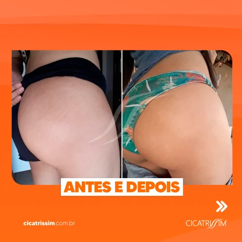 Antes e Depois Cicatrissim 2